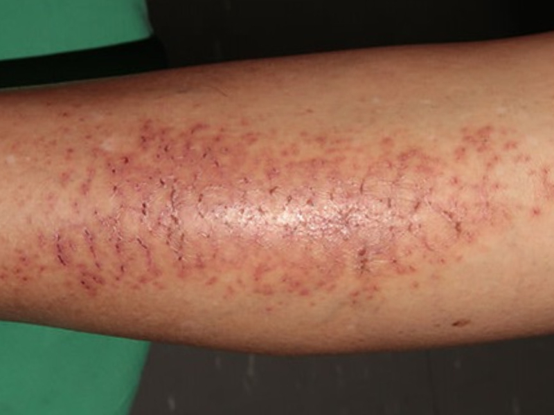 雙腿發癢兩個月 最終確為診肝癌