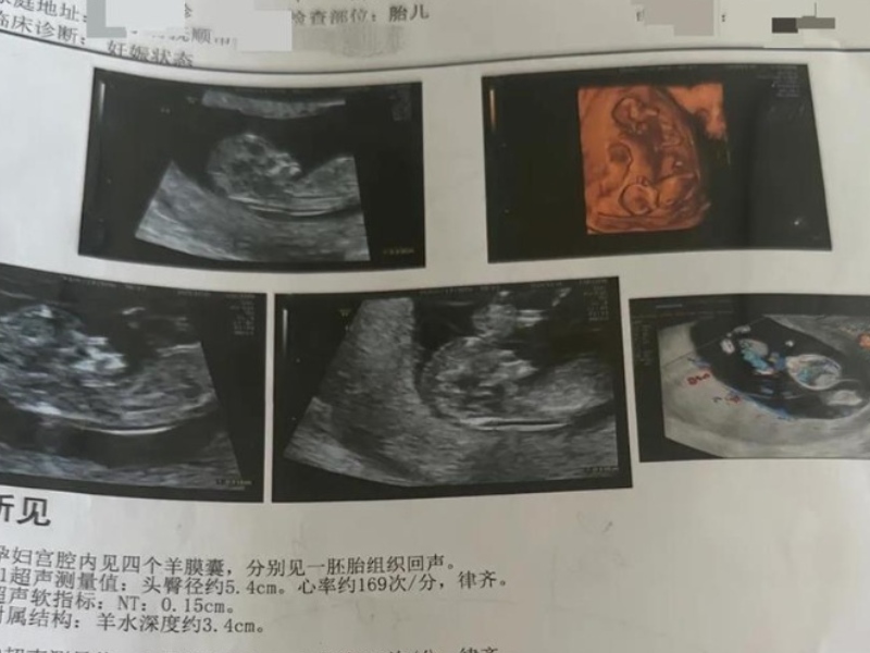 孕婦一胎變四胞胎，每次產檢多一胎