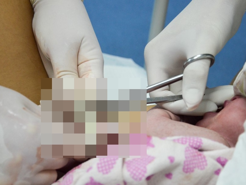 助產士剪臍帶時 不小心剪斷男嬰手指